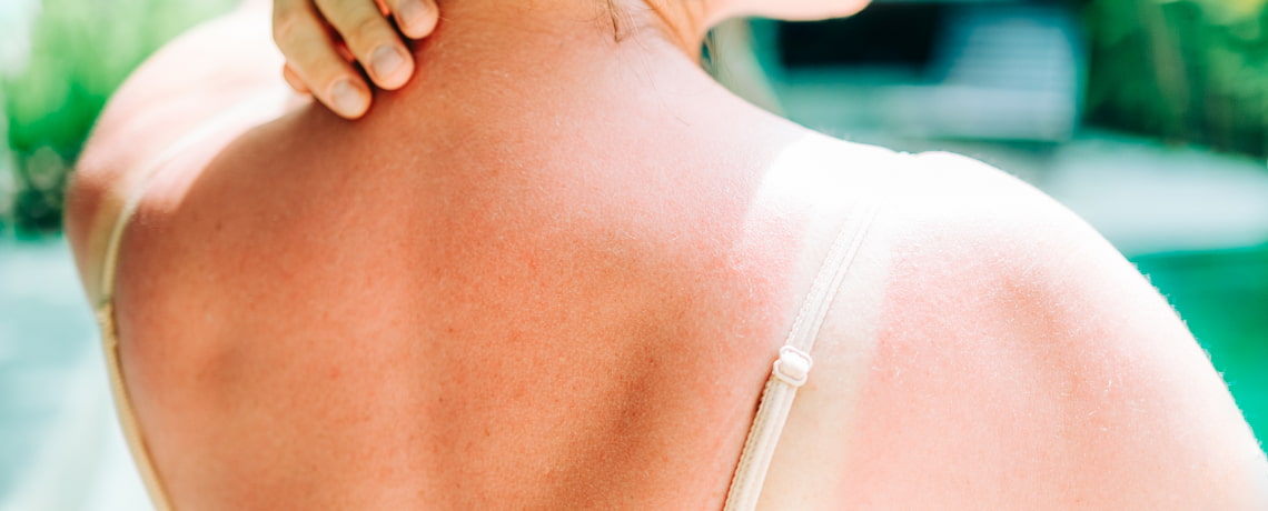 Une femme palpe un coup de soleil dans son dos