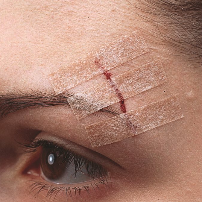 NEXCARE Steri Strip Wundverschlussstreifen, Bild 2 von 3