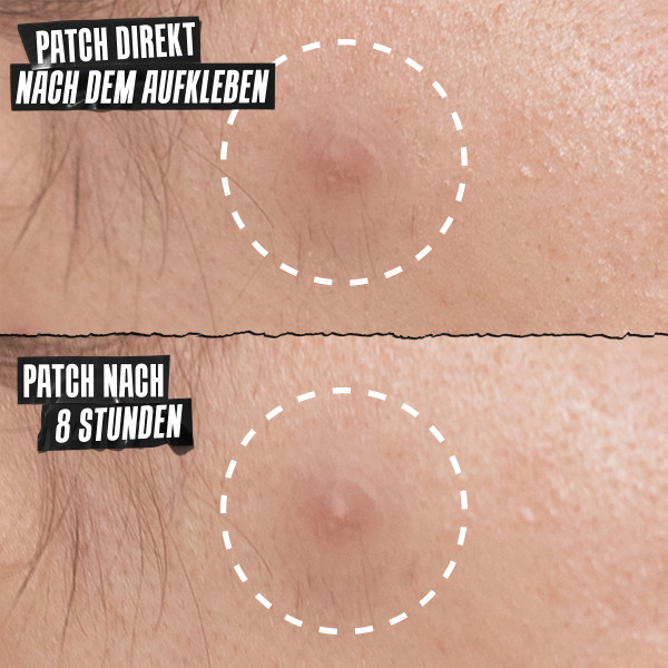 Kiehl's Acne Physical Patch ROW, image 4 sur 5
