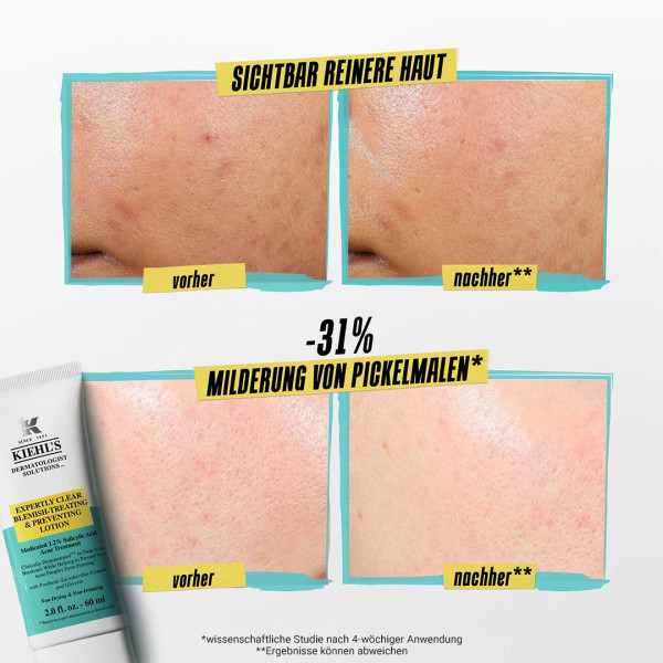 Kiehl's Acne Treatment, Bild 3 von 4