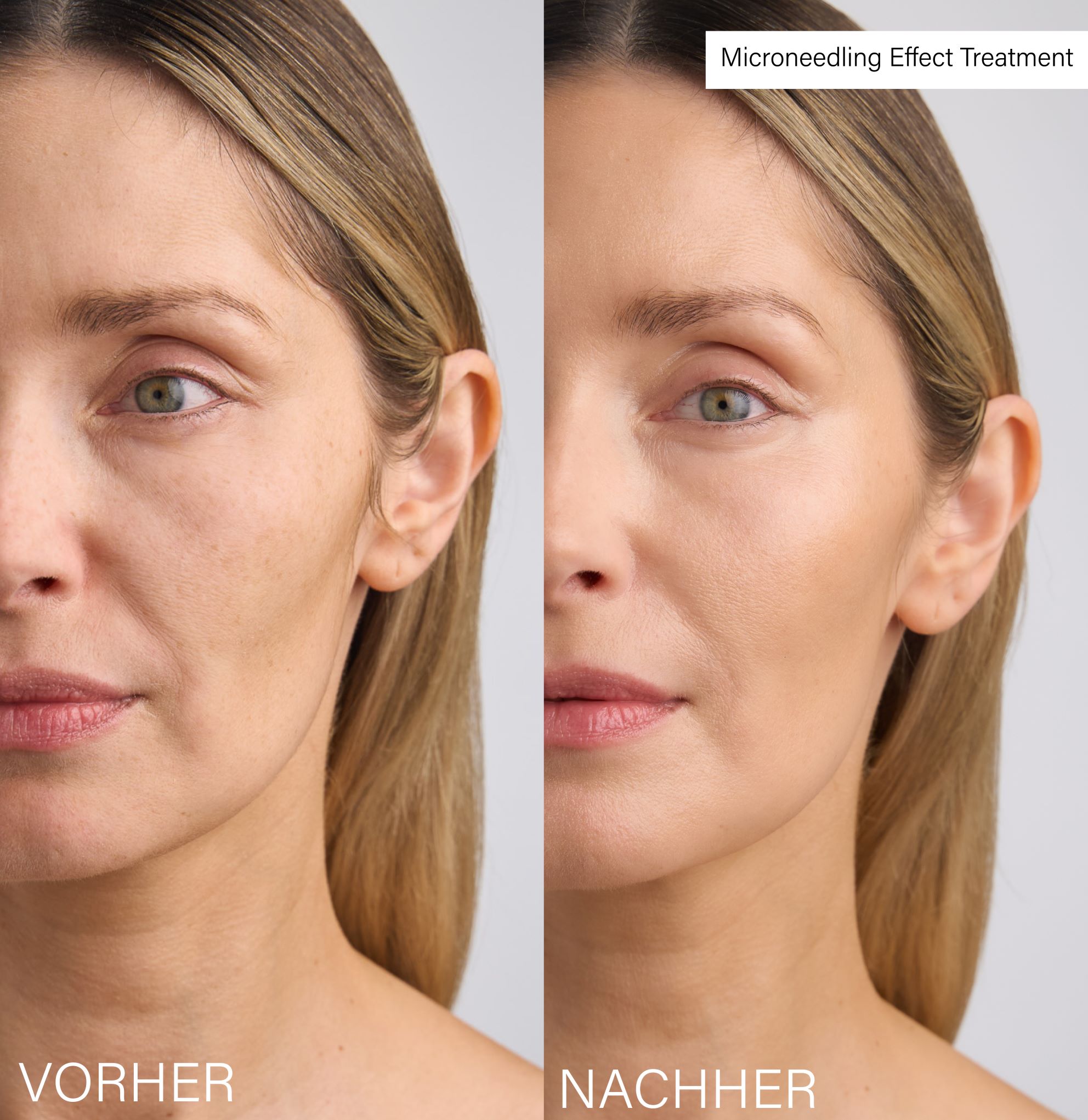 ROSENTAL Microneedling Effect Treatment, Bild 5 von 5